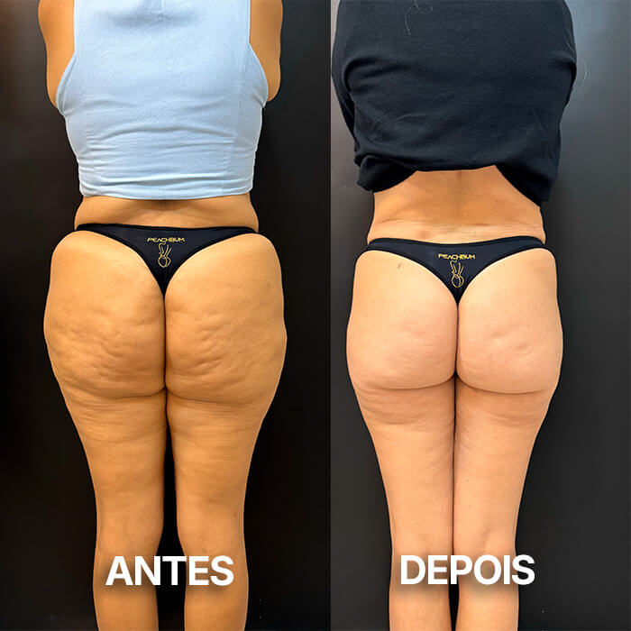 antesedepois