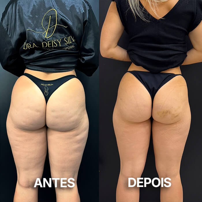 antesedepois2